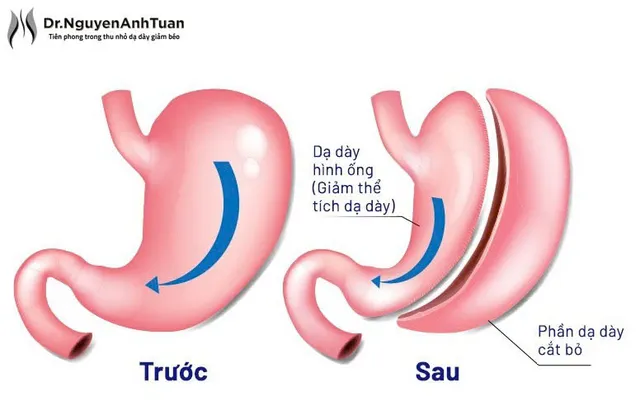 Phẫu thuật nội soi thu nhỏ dạ dày giảm béo: Những điều cần biết - Ảnh 1.