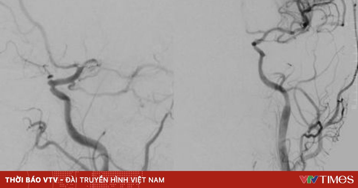 Nhồi máu não do không tuân thủ điều trị