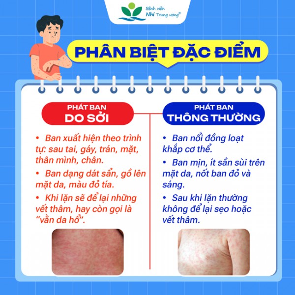 Bệnh sởi gia tăng: Những điều cha mẹ cần biết