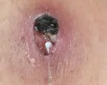 Phát hiện một ca mắc giun rồng tại Phú Thọ
