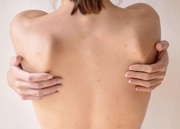 Cách điều trị mụn cơ thể và ngăn ngừa mụn vào mùa hè