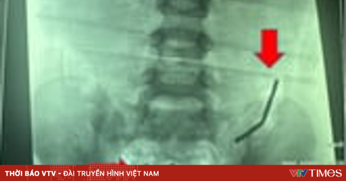 Bé trai thủng ruột 8 lỗ sau khi nuốt 20 viên nam châm Bé trai thủng ruột 8 lỗ sau khi nuốt 20 viên nam châm