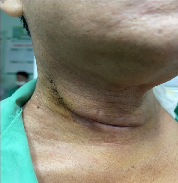 Khàn tiếng kéo dài, đi khám phát hiện mắc cùng lúc 2 loại ung thư