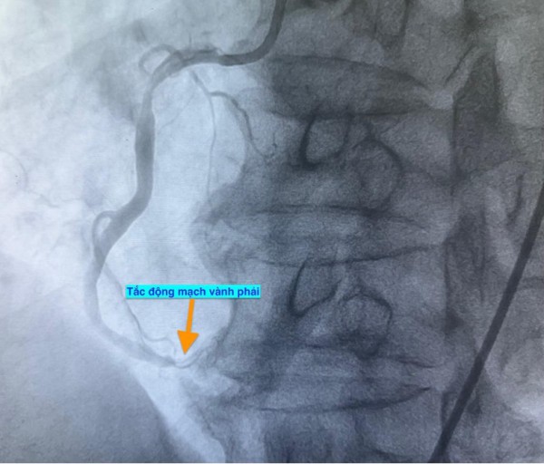 1 ngày 4 ca nhồi máu cơ tim cấp nhập viện, có bất thường? 1 ngày 4 ca nhồi máu cơ tim cấp nhập viện, có bất thường?