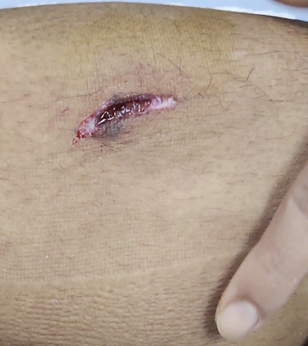 Trần Thành Trung chỉ bị khâu 5 mũi, vẫn kịp đá SEA Games 33: Thầy Kim thót tim