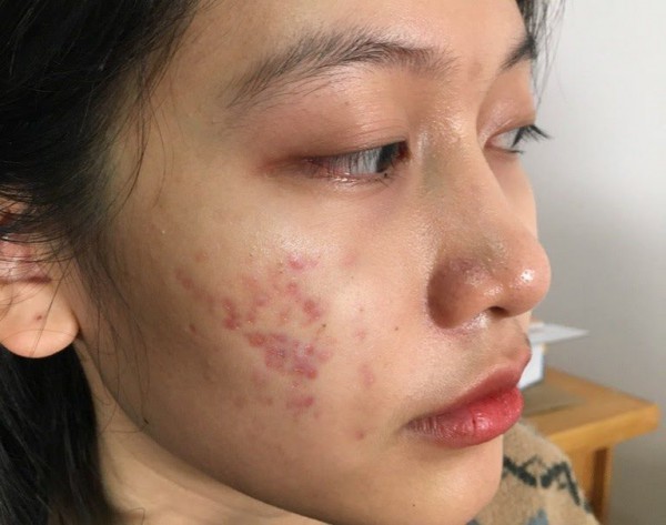 Tại sao mụn không nặn vẫn để lại vết thâm?