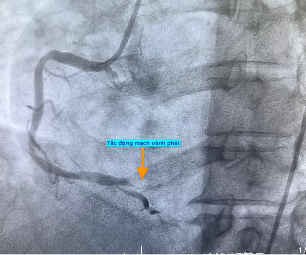 1 ngày 4 ca nhồi máu cơ tim cấp nhập viện, có bất thường? 1 ngày 4 ca nhồi máu cơ tim cấp nhập viện, có bất thường?