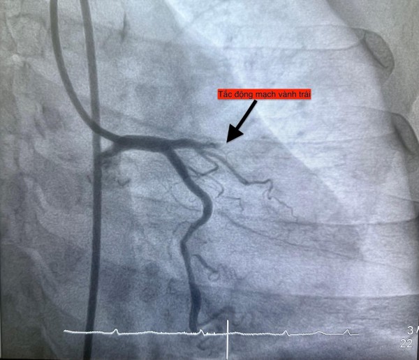 1 ngày 4 ca nhồi máu cơ tim cấp nhập viện, có bất thường? 1 ngày 4 ca nhồi máu cơ tim cấp nhập viện, có bất thường?