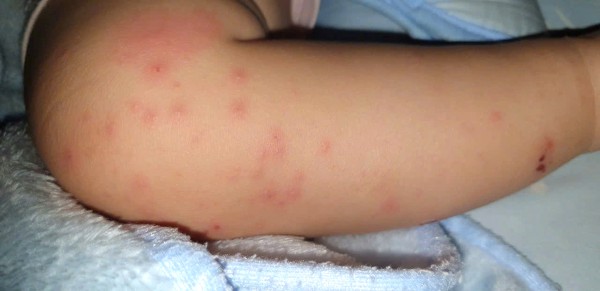 Chủng vi rút gây bệnh tay chân miệng nặng xuất hiện trở lại ở TP.HCM