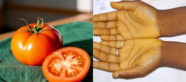 Ăn nhiều cà rốt, cà chua có thể khiến da đổi màu Ăn nhiều cà rốt, cà chua có thể khiến da đổi màu