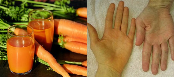 Ăn nhiều cà rốt, cà chua có thể khiến da đổi màu Ăn nhiều cà rốt, cà chua có thể khiến da đổi màu