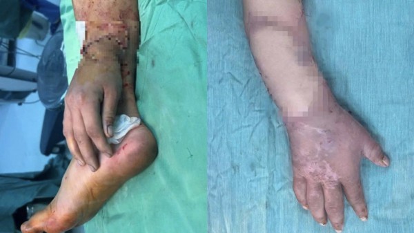 Bệnh viện đa khoa Bình Dương nối lại bàn tay đứt lìa cho thai phụ