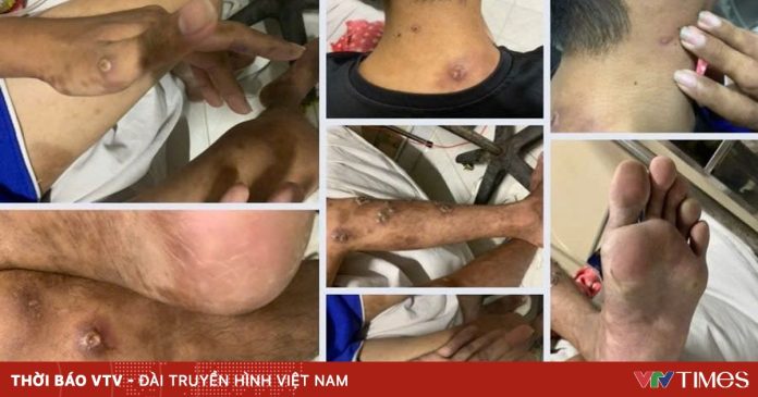 Đồng Nai ghi nhận ca bệnh đậu mùa khỉ chưa rõ nguồn lây Đồng Nai ghi nhận ca bệnh đậu mùa khỉ chưa rõ nguồn lây