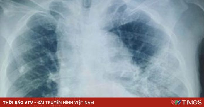 Viêm phổi do nấm Candida albicans ở người cao tuổi Viêm phổi do nấm Candida albicans ở người cao tuổi