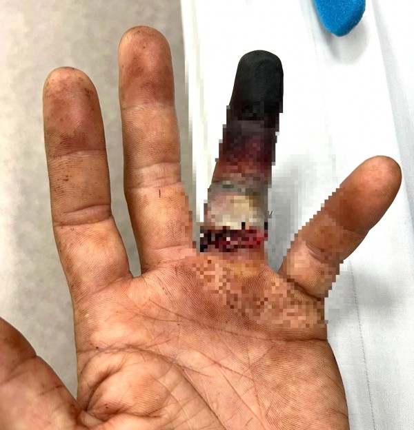 Nhẫn cưới mắc vào cửa xe, tài xế ở TP.HCM nguy cơ mất ngón tay