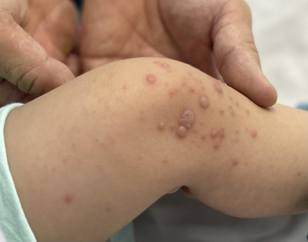 Việt Nam chờ vắc xin tay chân miệng nhập về hạ nhiệt dịch Việt Nam chờ vắc xin tay chân miệng nhập về hạ nhiệt dịch